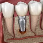 Dental Implant Cost