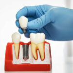 dental implants cost in london